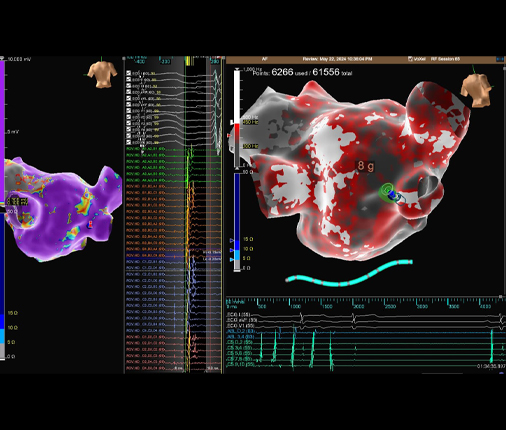 Fibrilación Auricular