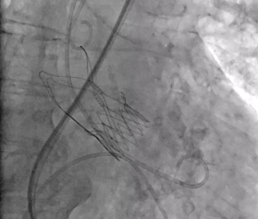   Ecocardiograma burbujas