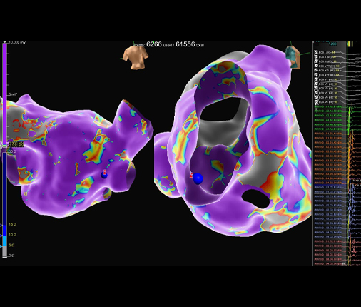 Mapeo electrofisiológico